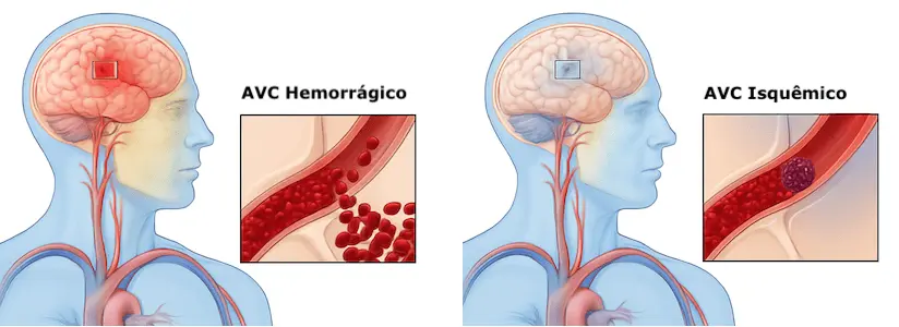 Diferença entre AVC isquêmico e Hemorrágico