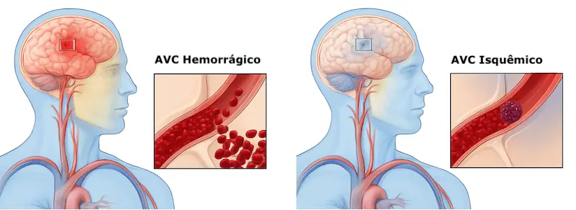 Diferença entre AVC isquêmico e Hemorrágico