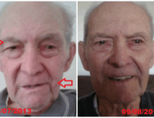 Fisioterapia na Paralisia Facial