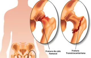 Fratura de quadril
