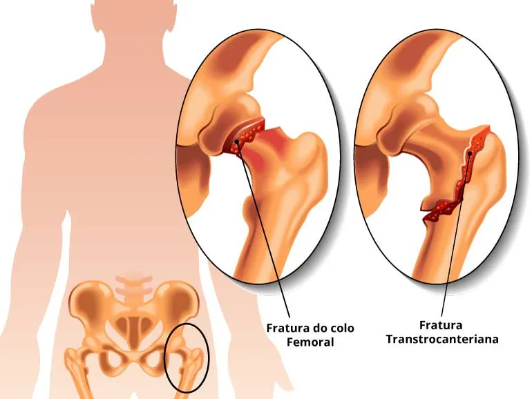 Fratura de quadril