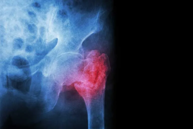 Raio-X fratura quadril