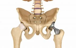 Artroplastia protese de quadril total