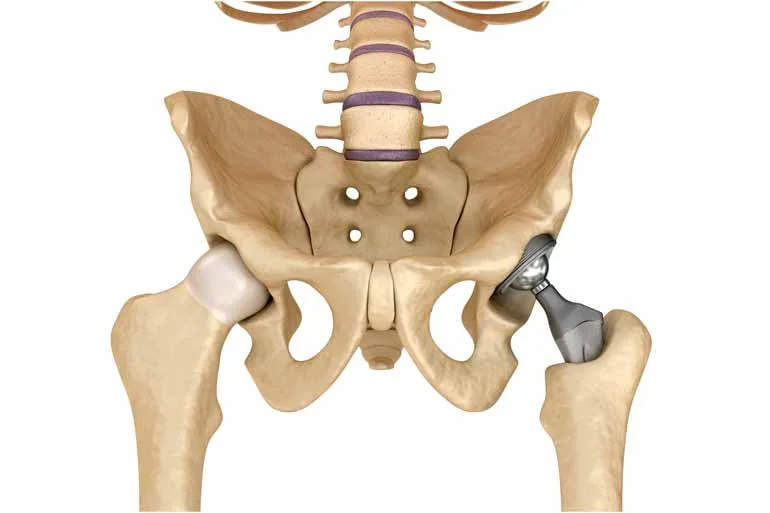 Artroplastia protese de quadril total