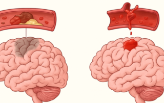 Isquemia e hemorragia cerebral